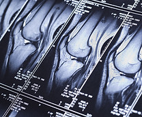 Knee mri