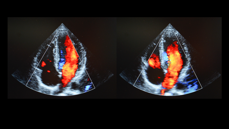 Echocardiogram Valley Imaging Center Wasilla, AK Diagnostic Medical Imaging Cardiac Ultrasound